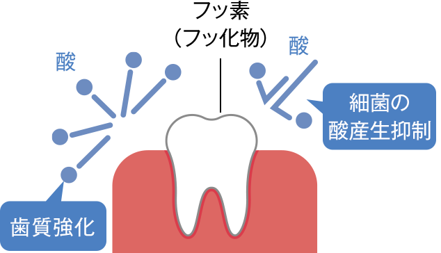 解説画像：フッ素でコーティングされ細菌の酸産生抑制する様子