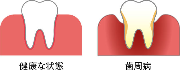 イラスト：[左]歯ぐきが健康な状態、[右]歯周病